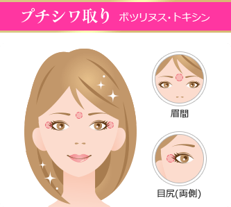 「プチシワ取り」ボツリヌス・トキシン