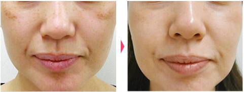 レーザートーニング:レーザーによるシミ・くすみ・肝斑・そばかす・クマ・毛穴の治療