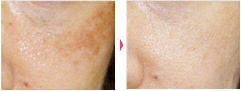 レーザートーニング:レーザーによるシミ・くすみ・肝斑・そばかす・クマ・毛穴の治療