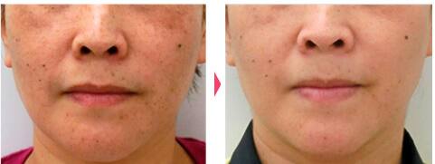 レーザートーニング:レーザーによるシミ・くすみ・肝斑・そばかす・クマ・毛穴の治療